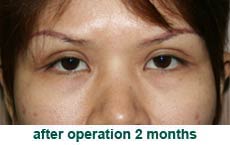 plastic-surgery-blepharoplasty